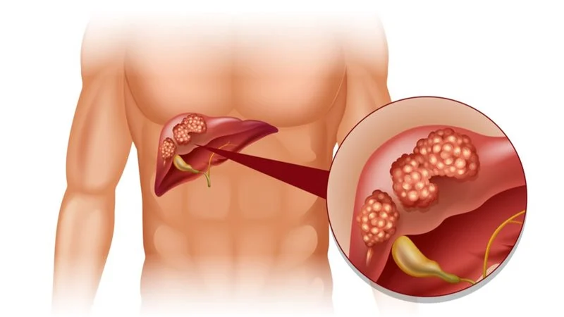 الصحة تحذر من زيادة خطر الوفاة لمرضى الكبد