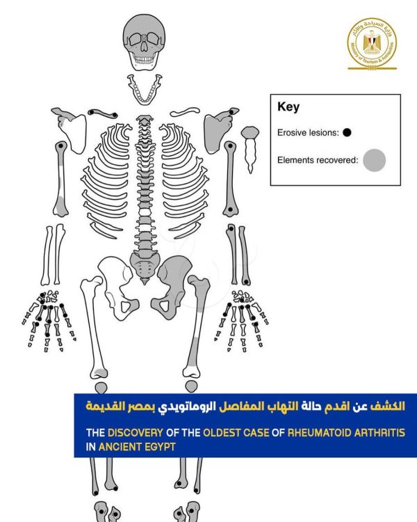 أقدم حالة التهاب مفاصل بالتاريخ