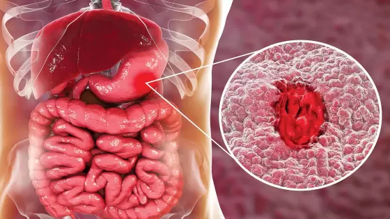 أبرزها عصير الليمون والبروكلي.. 5 أطعمة تقوي مناعتك ضد جرثومة المعدة