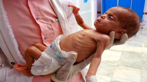 مأساة سوء التغذية في غزة